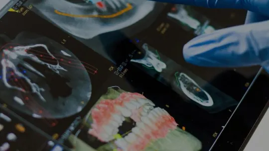 Máster de Formación Permanente en Implantología Avanzada, Cirugía Bucal e Implantoprótesis